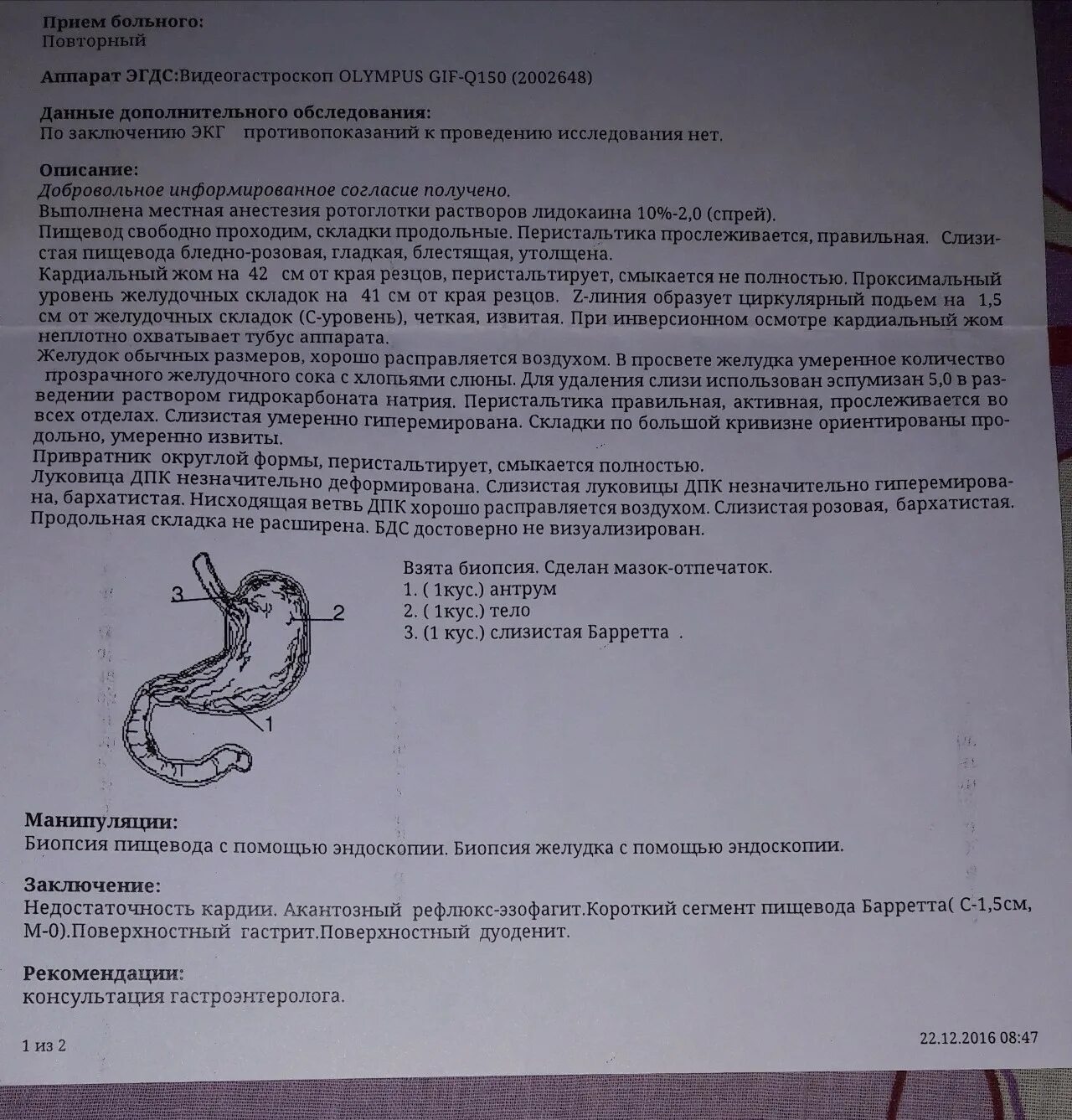 Показывает ли фгдс рак. Заключение поверхностный гастрит. эгдс заключение поверхностный гастрит. хронический гастрит . дуоденит заключение фгдс. поверхностный гастрит поверхностный дуоденит.