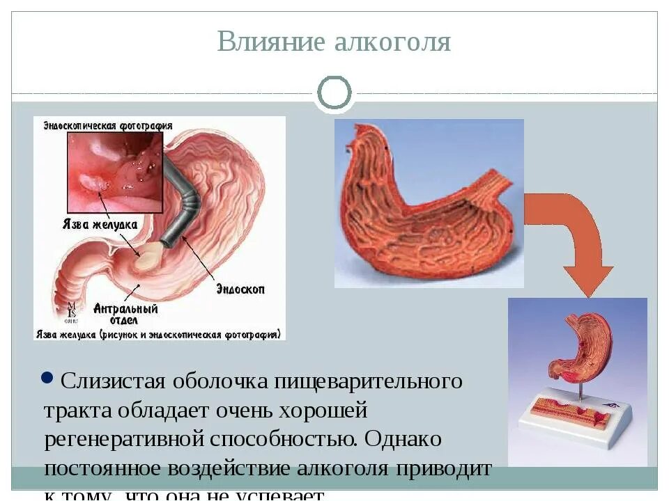 Печень влияет на желудок. Влияние спирта на желудок. Заболевания пищеварительной системы язва.