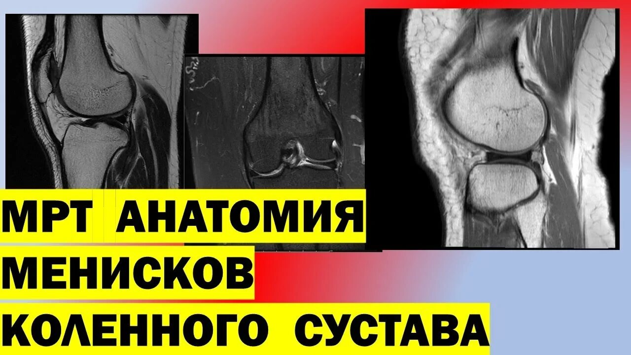 Анатомия менисков коленного сустава мрт. Коленный сустав на мрт анатомия мениск. Мрт коленного сустава разрыв мениска. Мениски коленного сустава анатомия.