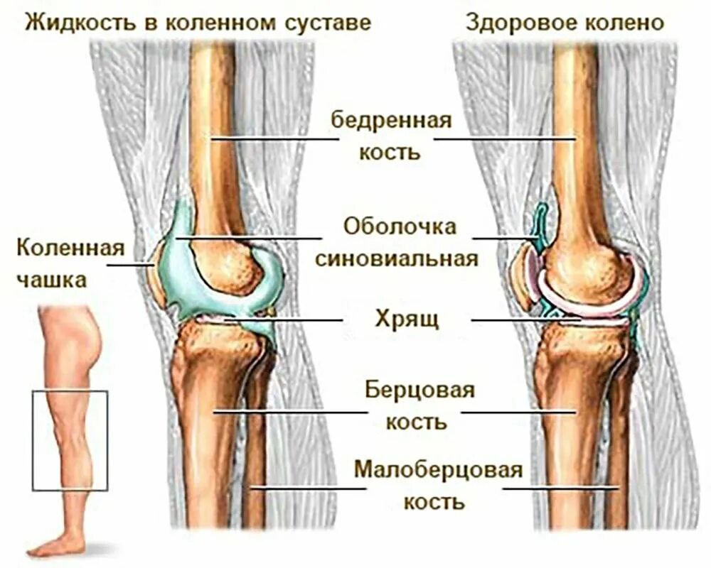 Синовиальная жидкость в коленном. Жидкость подколенного сустава. Жидкость внутри коленного сустава. Межсуставная жидкость в коленном суставе.