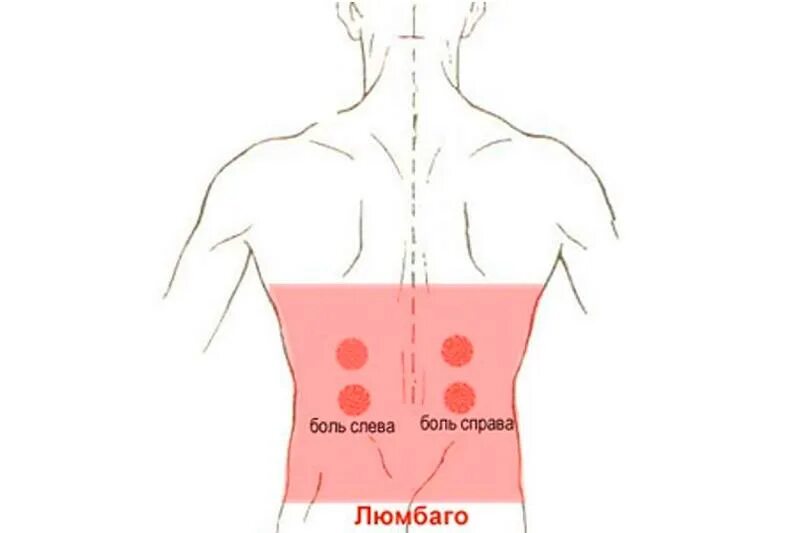 Поясница левая часть. Болит спина слева. Люмбаго. Простреливающая боль в спине. Люмбаго в пояснице.