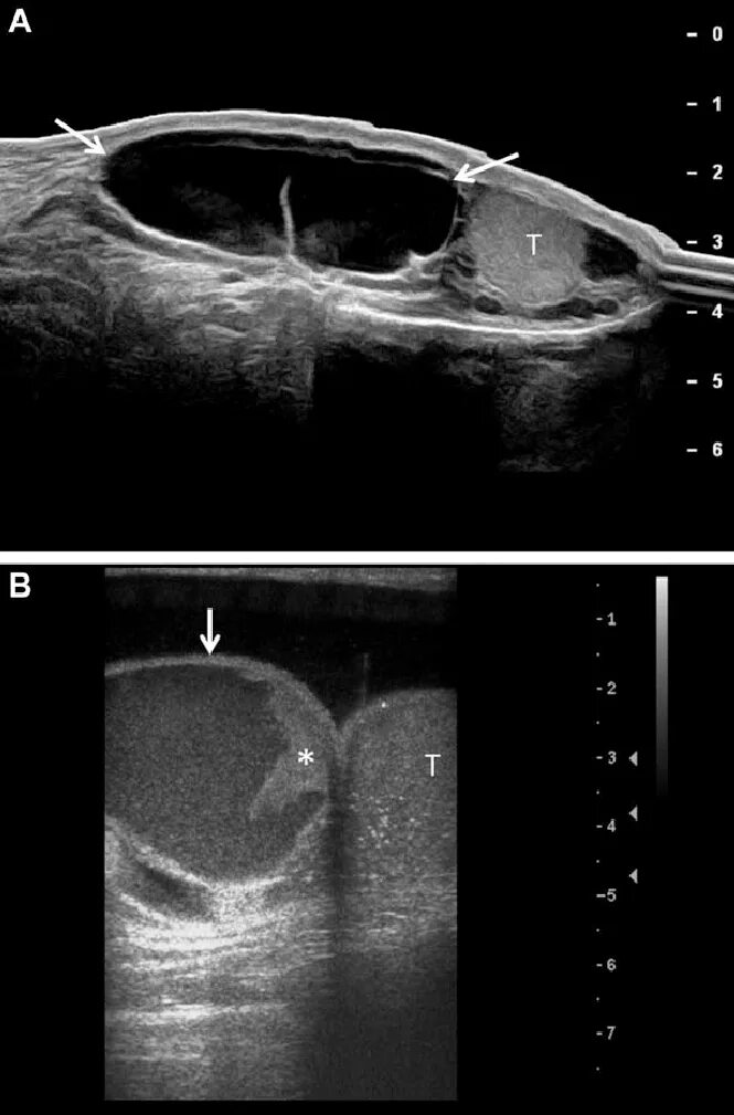 Сперматоцеле это. Сперматоцеле это. Сперматоцеле признаки. Сперматоцеле+варикоцеле. Сперматоцеле как определить.