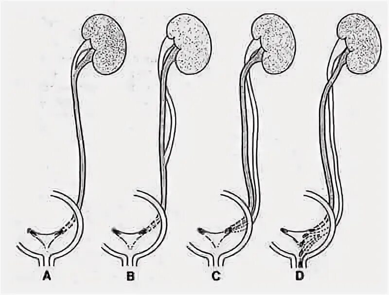 Удвоение мочеточника. Эктопия устья мочеточника. Интрамуральная эктопия мочеточника. Неполное удвоение почки. Неполное удвоение мочеточника.