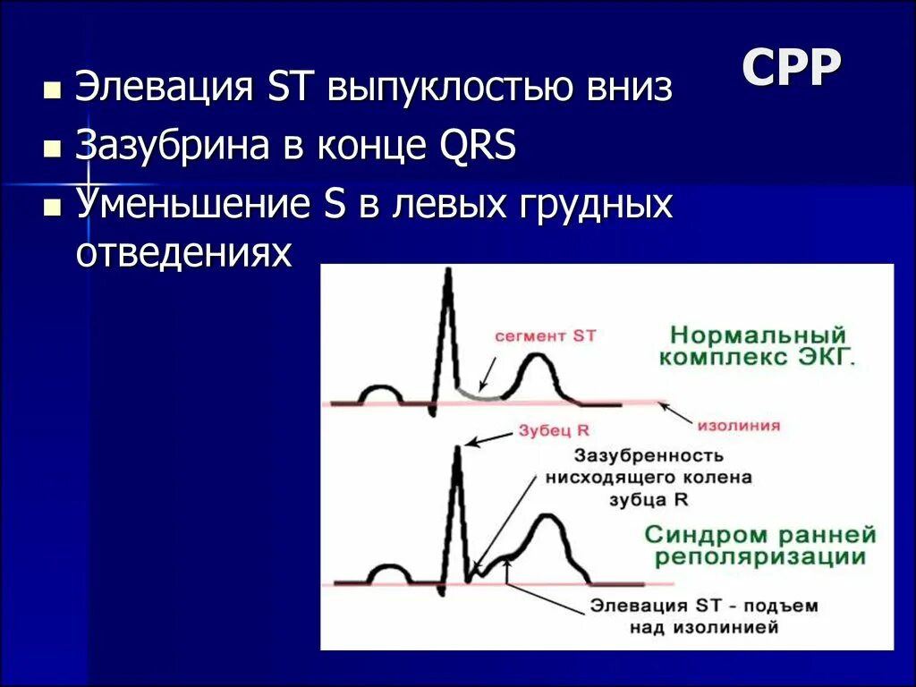 Эпизод депрессии st. Элевация сегмента St в отведениях II, III, AVF. Элевация сегмента St в v1-v6. Элевации сегмента St на ЭКГ. Элевация сегмента St на ЭКГ В грудных отведениях.