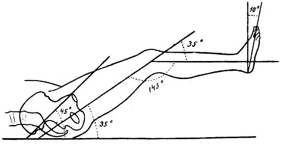 Варусная деформация оси нижних конечностей. Физиологическое положение. Положение тела или конечностей. Среднее физиологическое положение ноги. Вынужденное положение конечности.