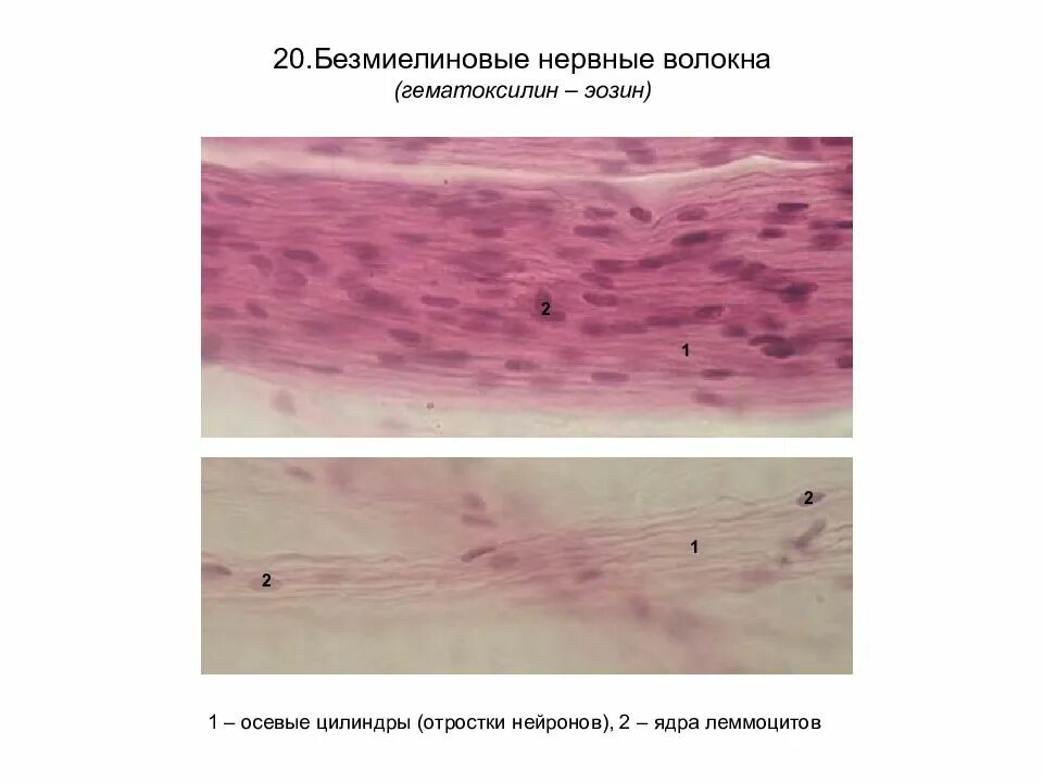 Безмиелиновые волокна гистология. Нервные волокна препарат. Безмиелиновые нервные волокна препарат. Миелиновые волокна гистология. Безмиелиновое волокно препарат гистология.