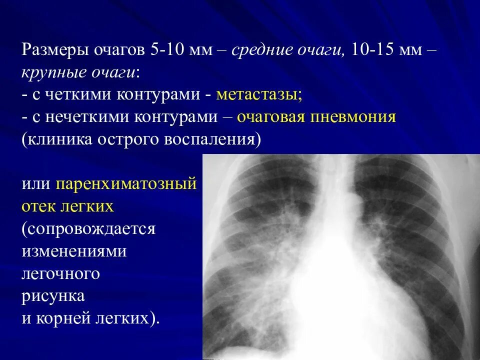 Очаги с нечеткими контурами. Очаговые тени средней интенсивности.