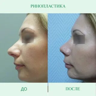 Отзывы после ринопластики форум