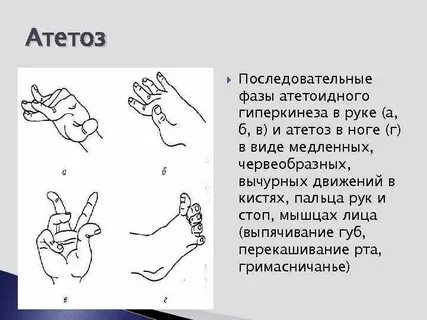 Гиперкинезы лица