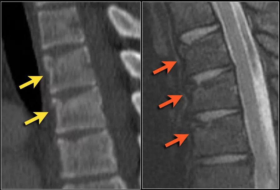 Компрессионный перелом позвонков мрт. Компрессионные переломы позвонков кт. Компрессионный перелом позвоночника th11-l1. Компрессионный перелом позвоночника мрт. Трещина кушать