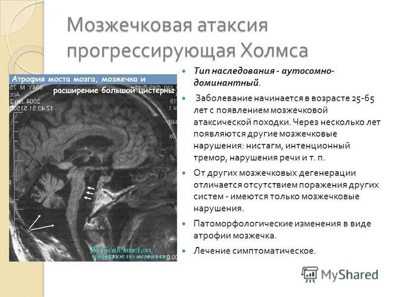 Атрофия мозга лечение. Мрт при мозжечковой атаксии. Оливопонтоцеребеллярная дегенерация мрт. Церебеллярная дегенерация мозжечка.