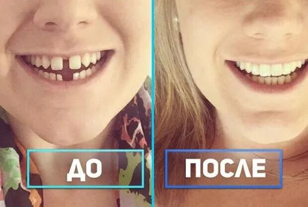 После 10. Катя Адушкина до брекетов. Катя Адушкина зубы. Катя Адушкина брекеты до и после.