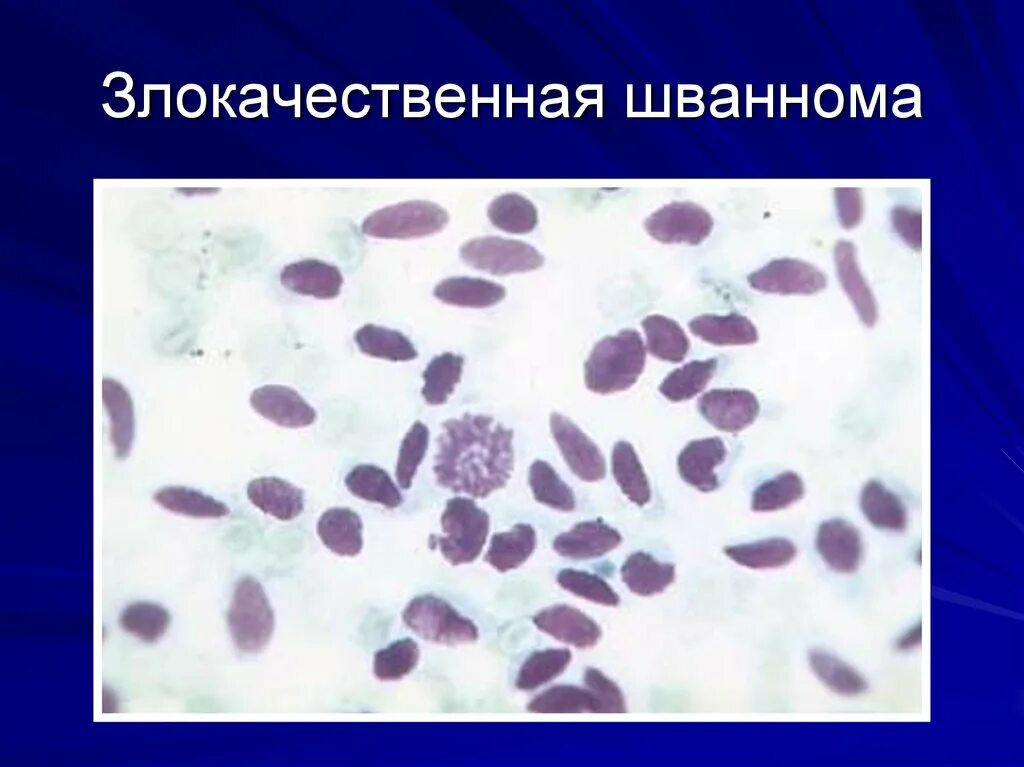 Злокачественная шваннома. Шваннома (неврилеммома, невринома). Злокачественная невринома. Злокачественная шваннома гистология. Шваннома желудка гистология.