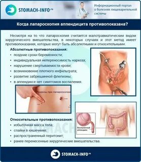 Как определить аппендицит самостоятельно у женщин
