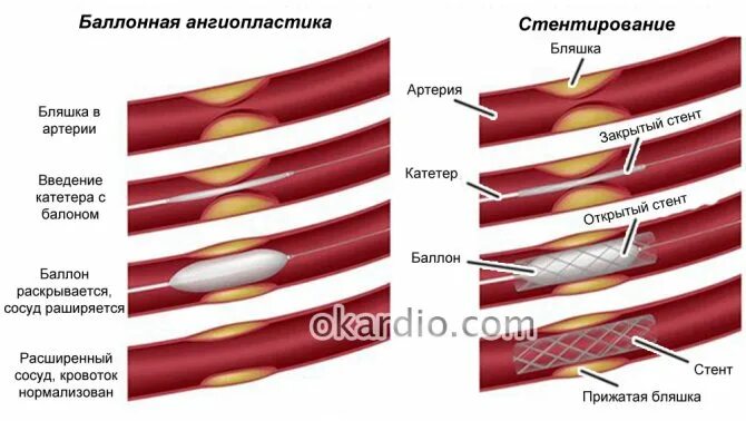 Баллонная ангиопластика нижних конечностей. Баллонная ангиопластика и стентирование. Баллонная ангиопластика сосудов сердца. Лазерная ангиопластика сосудов нижних конечностей. Коронарная ангиопластика и стентирование.