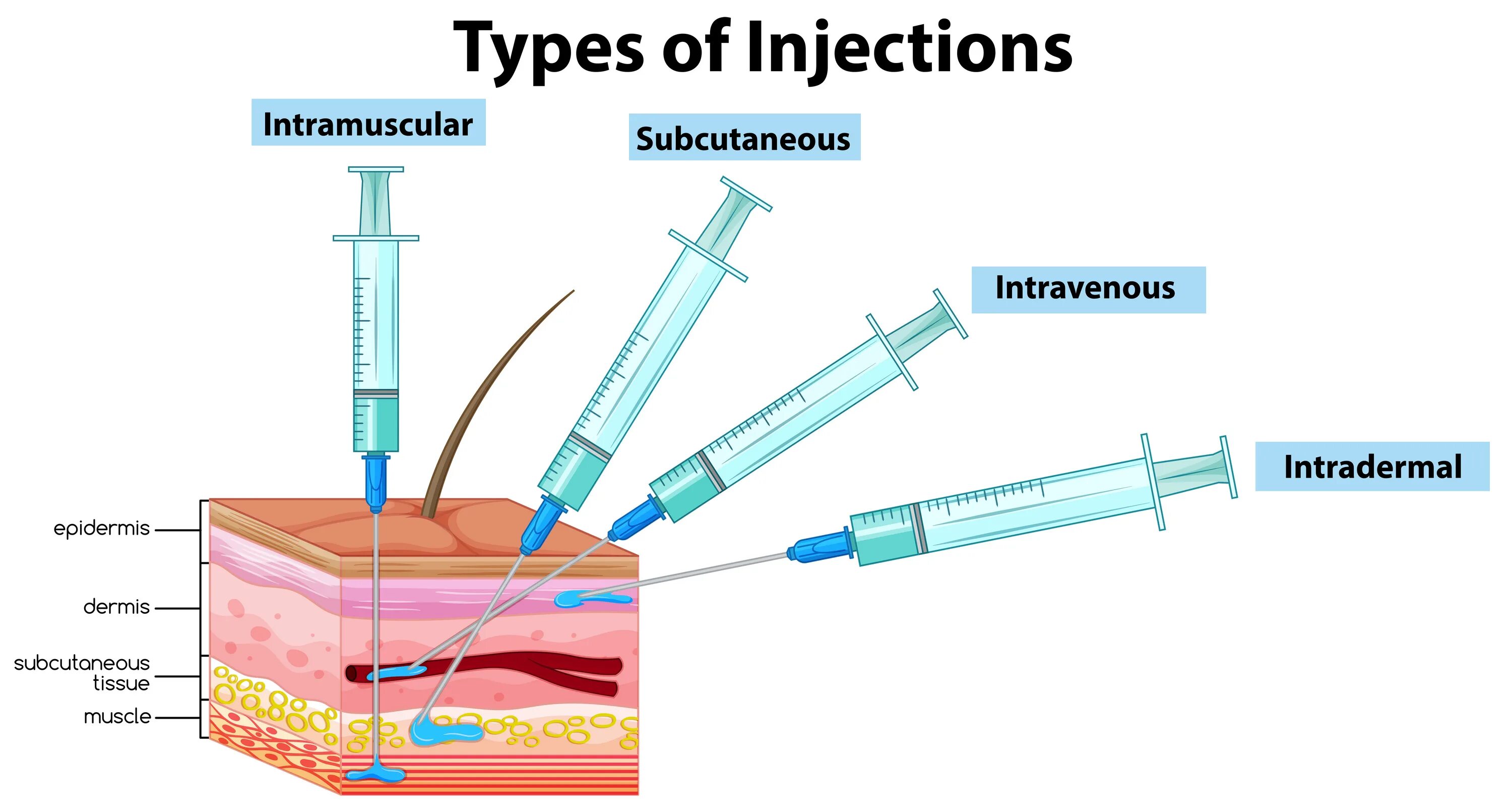 Углы введения инъекций. Подкожные внутримышечные и внутривенные инъекции. Шприц для проведения инъекций.