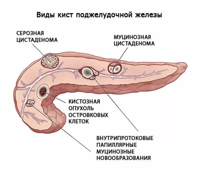 Панкреатит головка. Кисты поджелудочной железы классификация. Доброкачественные эпителиальные опухоли поджелудочной железы. Кисты поджелудочной железы кт классификация. Кистозные образования поджелудочной железы.