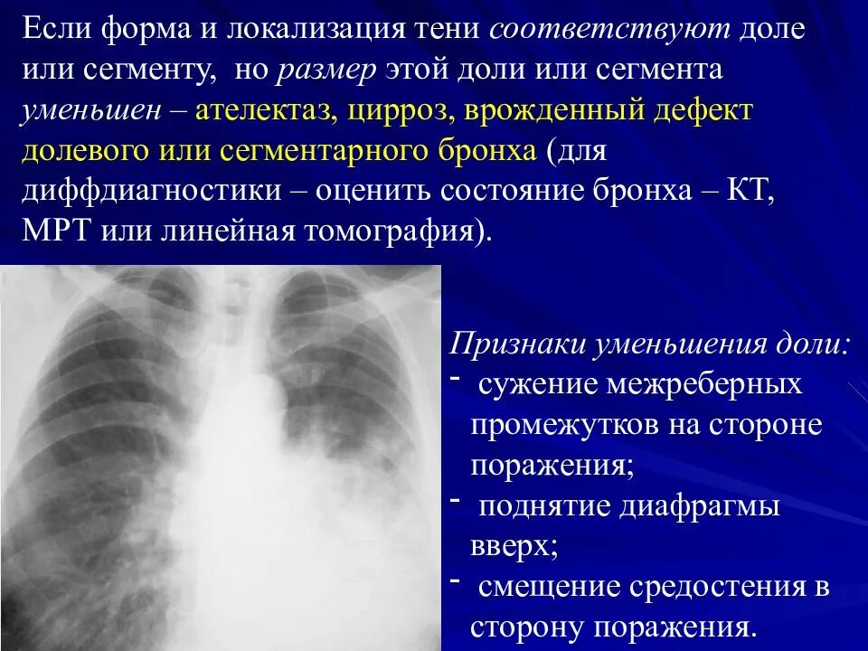 Ателектаз левой доли легкого. Ателектаз сегмента. Ателектаз доли. Ателектаз нижней доли правого легкого рентгенограмма. Ателектаз нижней доли легкого.