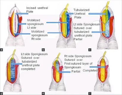 Diagrammatic representation of double breasting of corpus spongiosum... Download