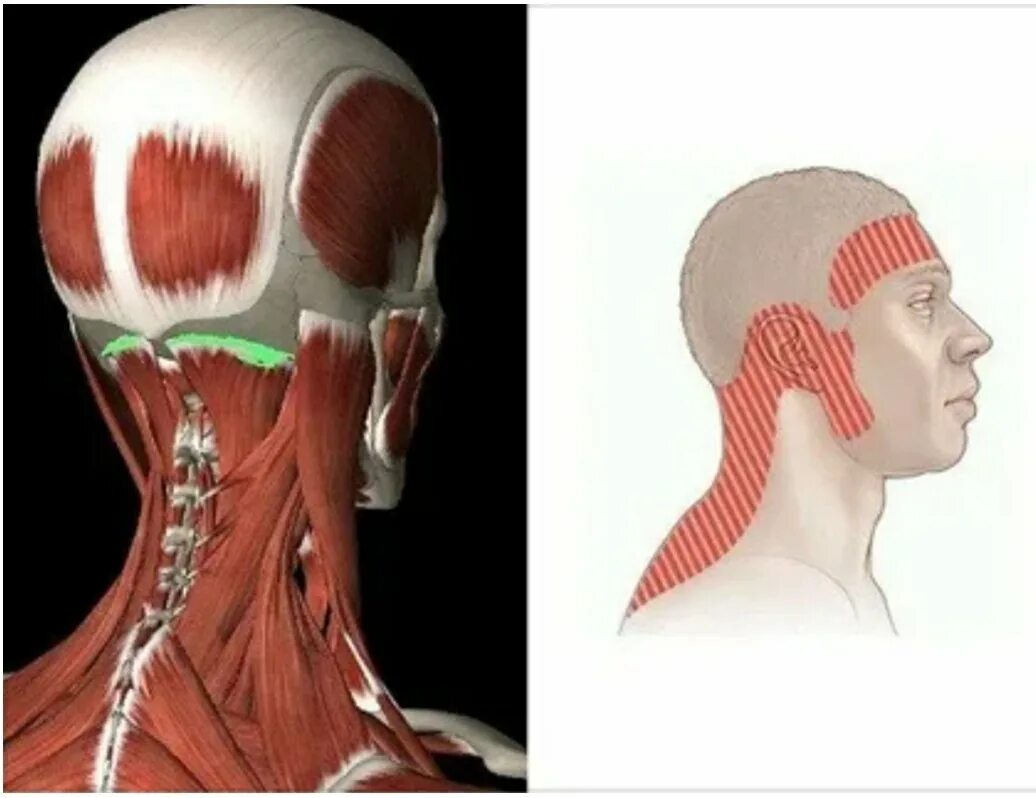 Боли в шее у основания черепа. Мышцы затылка. Мышцы на затылке головы.