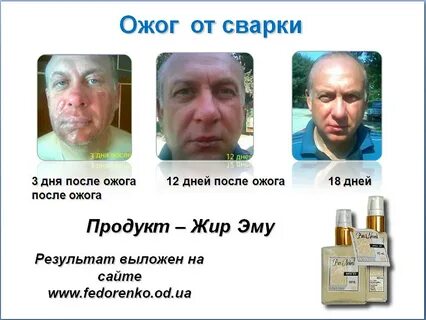 Лечение после сварки