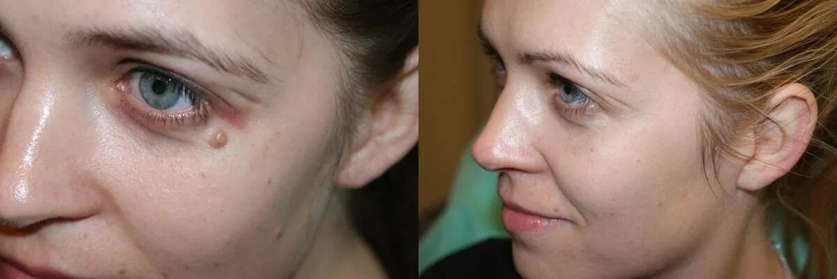 Комочки биша до и после. Коррекция овала лица филлерами. Как выглядит лицо после удаления. Бородавки на лице до и после. Как выглядит лицо после удаления.