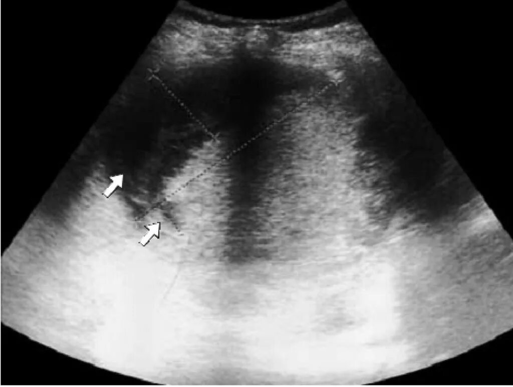 На узи увеличена селезенка. Анатомия селезенки на узи. Увеличенная селезенка на узи. Спленомегалия селезенки узи. Спленомегалия селезенки узи.