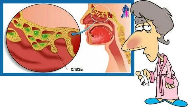 Заложенность носоглотки. Сопли заложенность носа. Почему носом без соплей