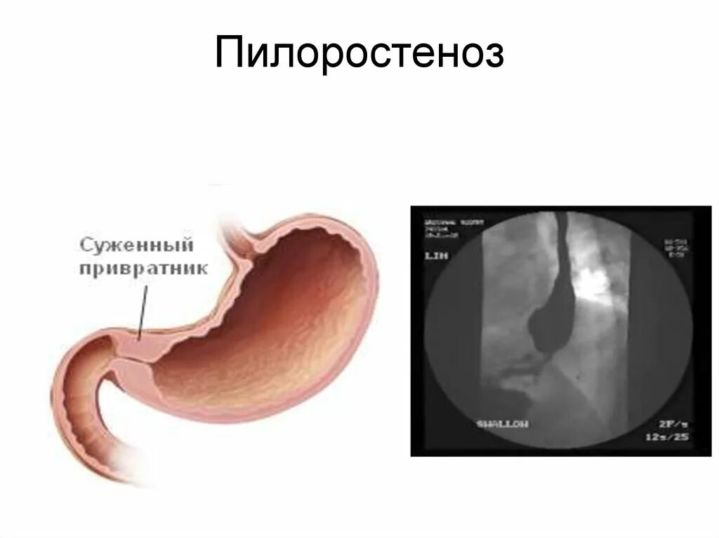 Врожденный пилоростеноз рентгенограмма. Пилородуоденальный стеноз эндоскопия. Язвенный стеноз привратника желудка. Псевдопилоростеноз и пилоростеноз. Стеноз прямой