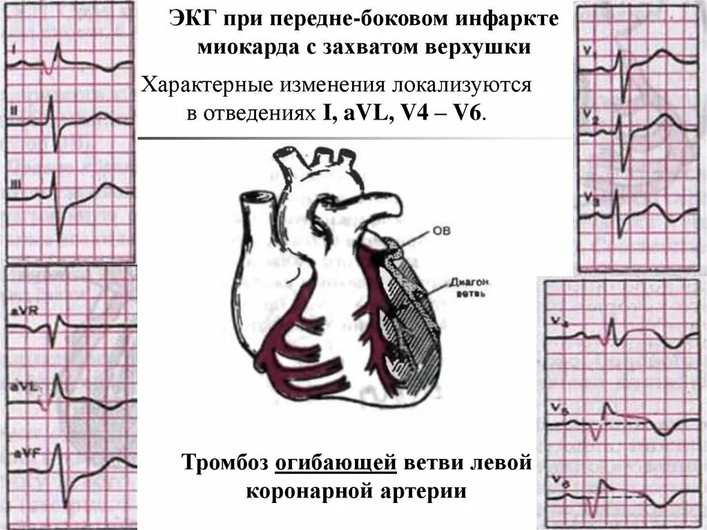 Инфаркт миокарда передней локализации ЭКГ. Инфаркт боковой стенки на ЭКГ. Верхушечный инфаркт миокарда на ЭКГ. Старый инфаркт миокарда передней стенки ЭКГ. Изменения в нижней стенке левого желудочка