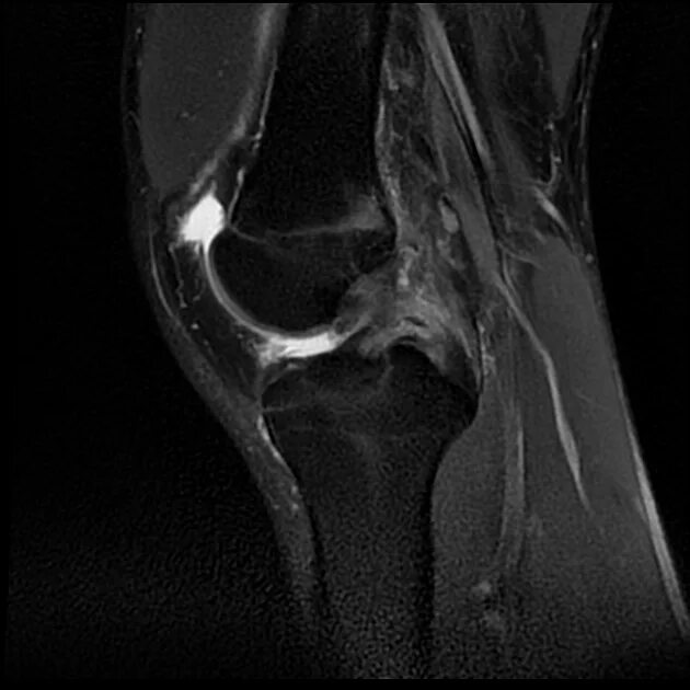 Хондромаляция бедренной кости мрт. Хондромаляция надколенника рентген. Хондромаляция надколенника на кт. Хондромаляция медиального мениска. Хондромаляция медиальных мыщелков