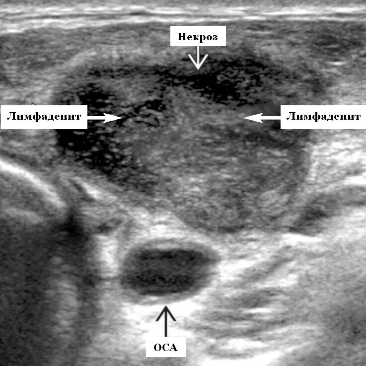 Биопсия лимфоузлов заключение. Эхогенность лимфатических узлов. Узи аксиллярных лимфоузлов. Норма лимфатических узлов узи заключение. Узи диагностика лимфатических узлов.