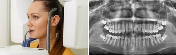 Снимок будут делать. Ортопантомография ВНЧС. Ортопантомограмма пародонтит. Панорамный снимок челюсти. Рентгеновский снимок зуба.