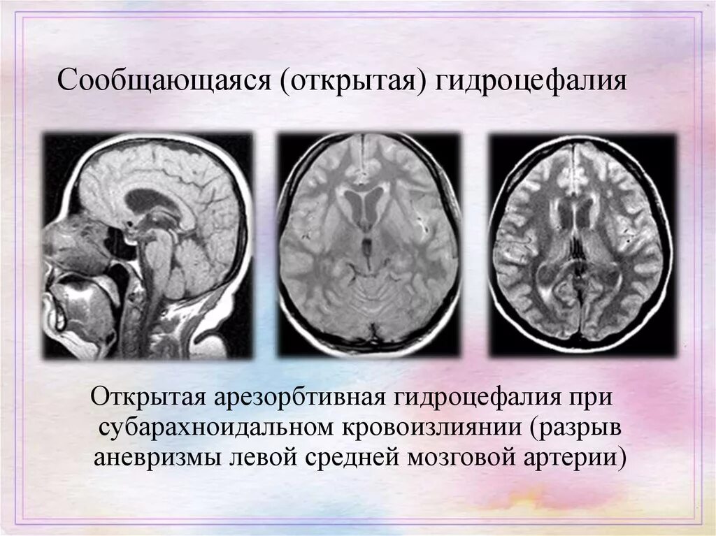 Гидроцефалия УЗИ головного мозга. Наружная гидроцефалия головного мозга кт. Арезорбтивная гидроцефалия. Викарная наружная сообщающаяся гидроцефалия.