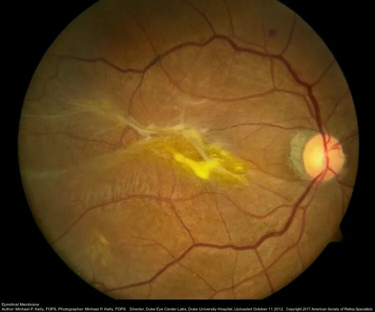 Эпиретинальный фиброз глаза. Макулярный фиброз сетчатки. Эпиретинальная мембрана сетчатки. Эпиретинальный макулярный фиброз. Эпиретинальная мембрана (целлофановая макула).