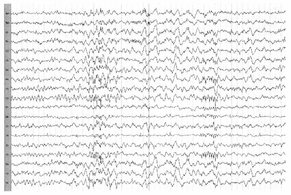 Позитивные 6-14 Гц Спайк волны в ЭЭГ. 6-8 Гц спайки ЭЭГ. Спайк волна на ЭЭГ. 6-14 Спайки ЭЭГ. Спайк на ээг