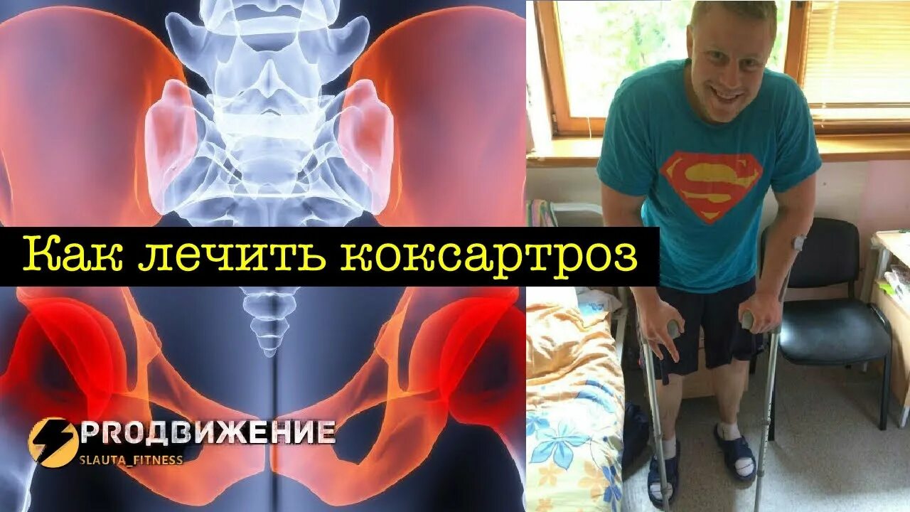 Какая боль при коксартрозе. Обезболивающая мазь при коксартрозе тазобедренного сустава.