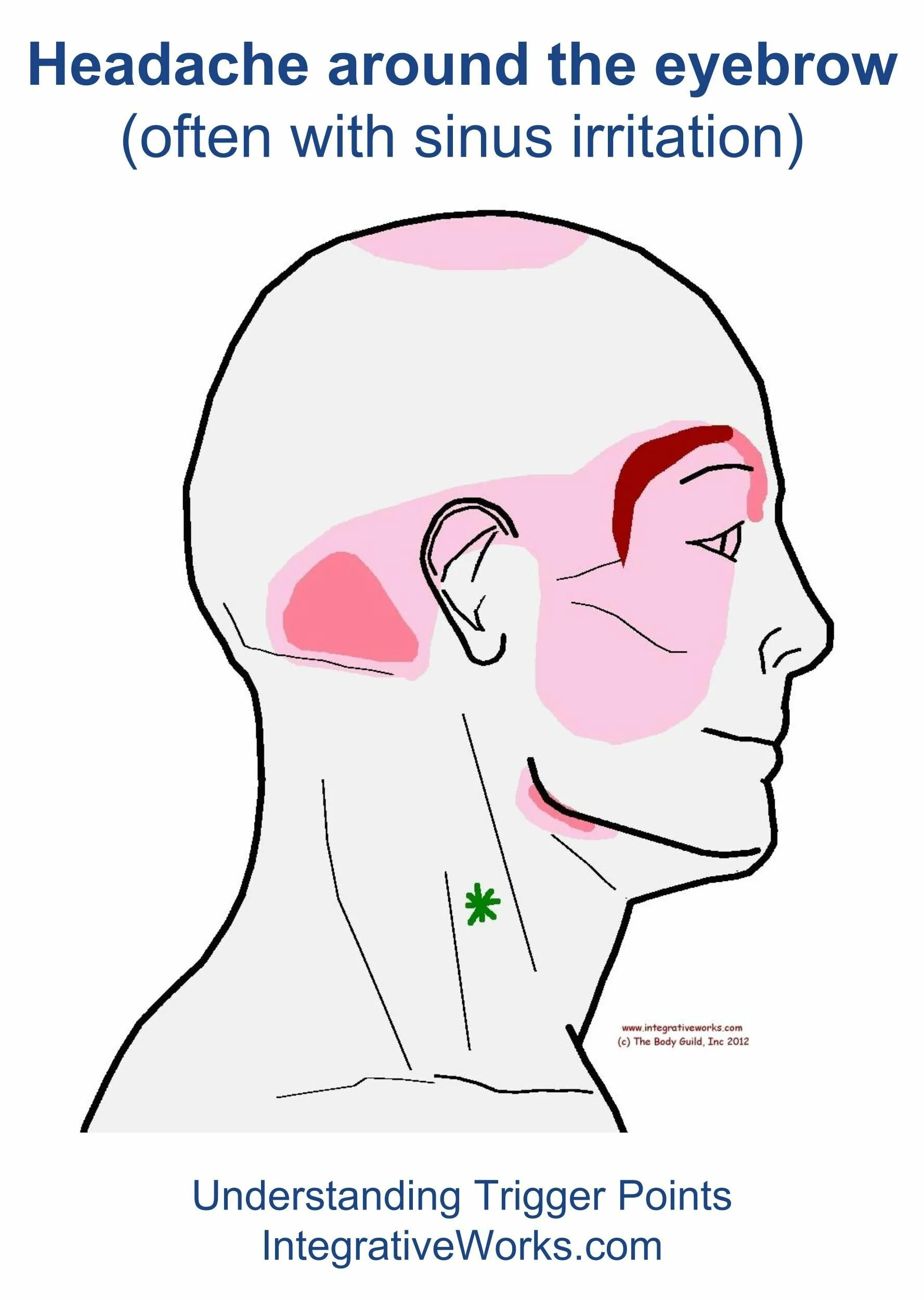 Голова левая сторона затылок. Головная боль триггерные точки. Зоны головных болей головы. Болит затылок справа. Болит в Виске.
