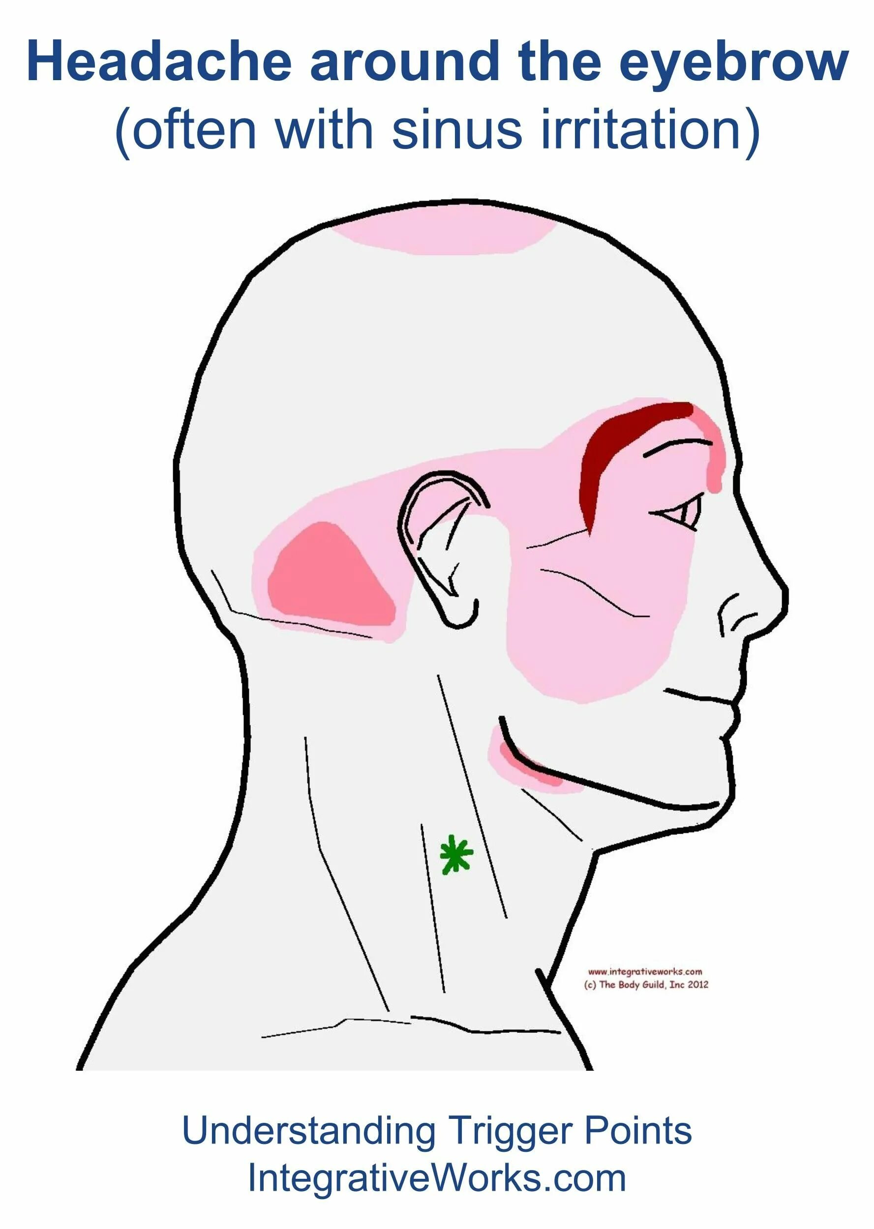 Головная боль триггерные точки. Зоны головных болей головы. Болит затылок справа. Болит в Виске.