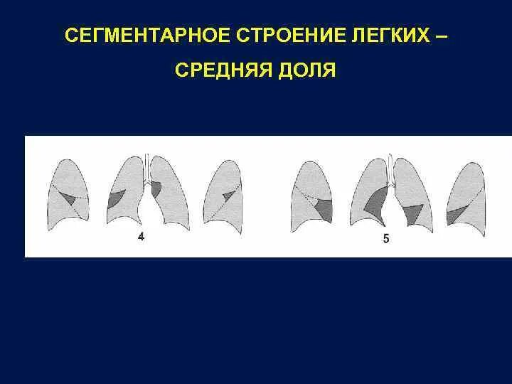 Ателектаз левой доли легкого. Ателектаз нижней доли правого легкого рентген. Схемы ателектазов долей легких. Ателектаз 3 сегмента правого легкого рентген. Дисковидный ателектаз нижней доли.