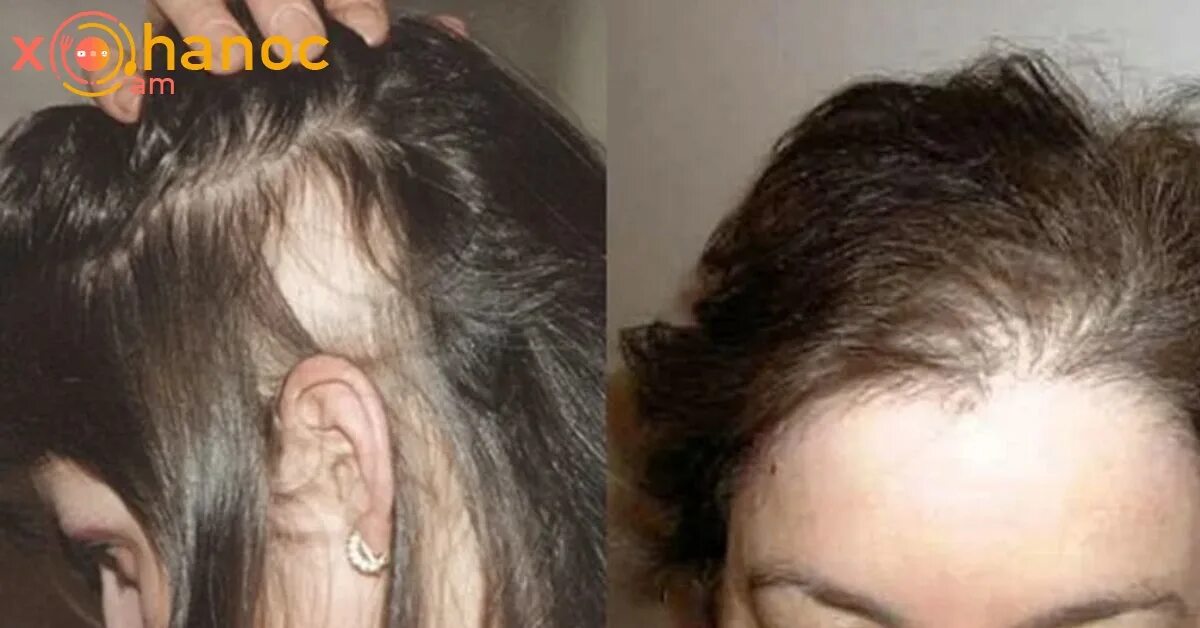 Что можно сделать если сильно. Послеродовая телогеновая алопеция. Сильное выпадение волос. Очень сильно выпадают волосы. Последствия выпадения волос.