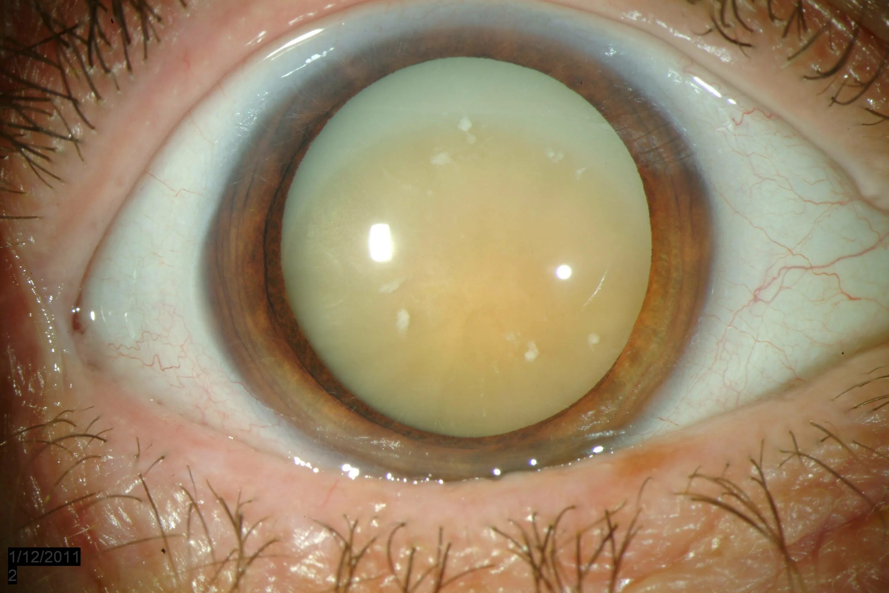 Переднекапсулярная катаракта. Морганиевая катаракта. Миопизирующая катаракта. Передне капсулярная катаракта. Причины глаукомы глаза