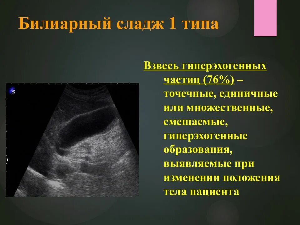 Гиперэхогенные включения в желчном пузыре. Сладж-синдром желчного пузыря. Билиарный сладж.