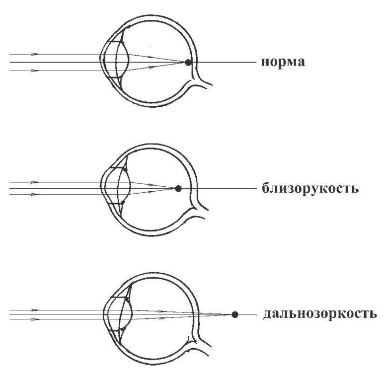 Миша страдает близорукостью а его брат дальнозоркостью. Схемы рефракции при нормальном зрении. Схемы рефракции при нормальном зрении при миопии при гиперметропии. Нарушение рефракции глаза схема. Схема преломления лучей при нормальной рефракции.