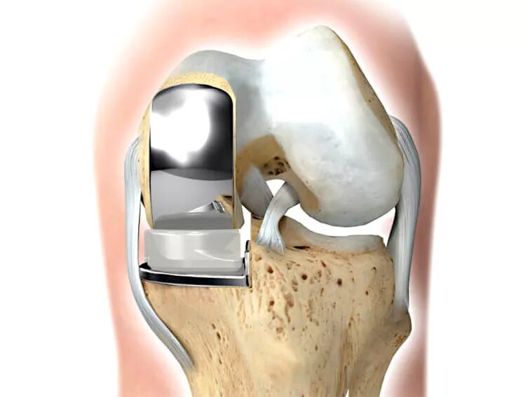 Эндопротез мыщелка коленного сустава. Одномыщелковое эндопротезирование коленного сустава. Тотальное цементное эндопротезирование коленного сустава. Однополюсной эндопротез коленного сустава. Операции на коленном суставе стоимость