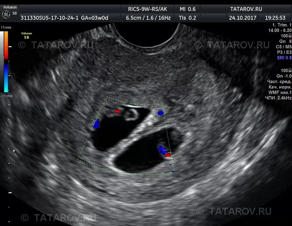 УЗИ двухплодной беременности. Два плодных яйца на УЗИ 5 недель беременности. Как выглядит эмбрион в 5 недель на УЗИ. УЗИ многоплодной беременности 5 недель. Плодное яйцо 5 недель форум