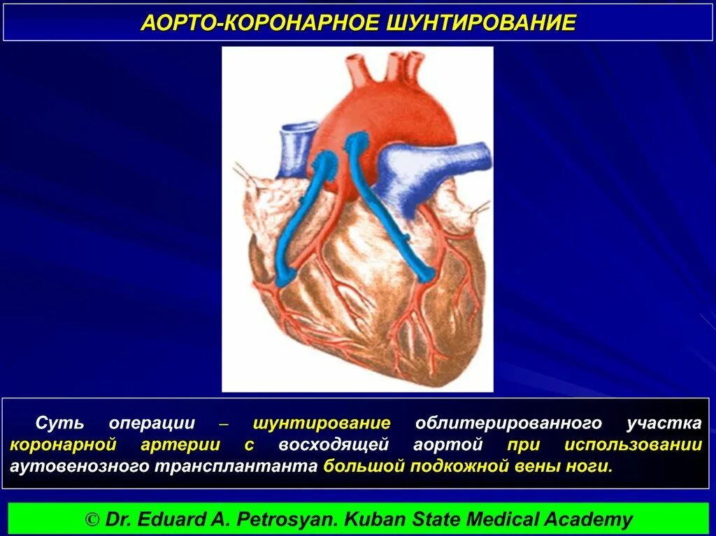 Маммарокоронарное шунтирование сердца. Коронарное шунтирование сосудов сердца. Схема операции аортокоронарного шунтирования. Артерио коронарное шунтирование. Как делают коронарное шунтирование
