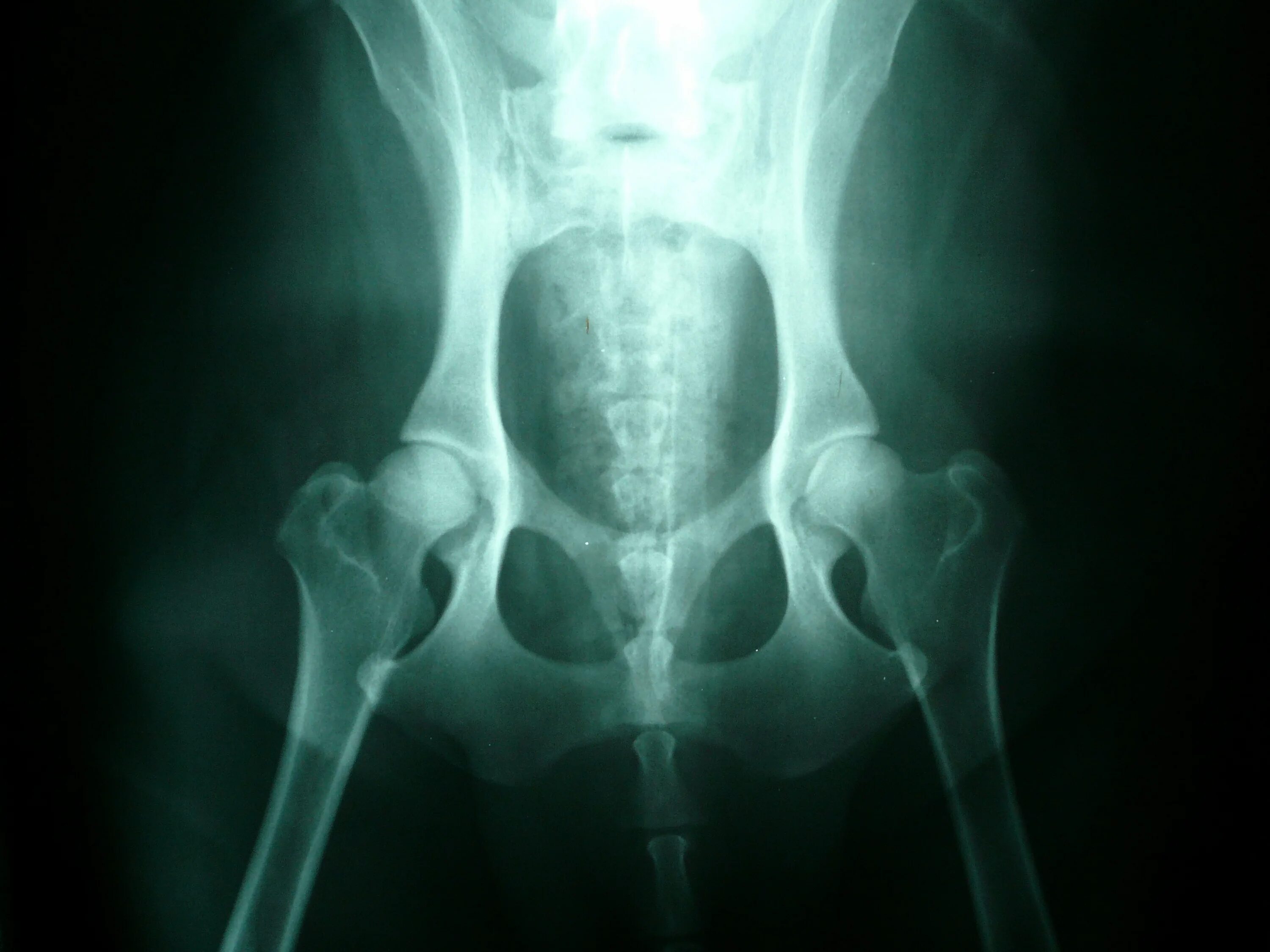 Тазобедренный артрит у ребенка. Дисплазия тазобедренных суставов рентген. Дисплазия тазобедренных суставов у собак рентген снимки. Дисплазия тазобедренного сустава у собак рентген. Септический артрит тазобедренного сустава рентген.