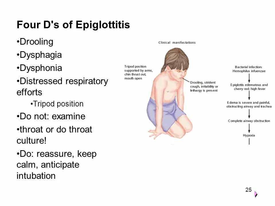 Эпиглоттит симптомы. Эпиглоттит положение ребенка. Вынужденное положение при эпиглоттите.