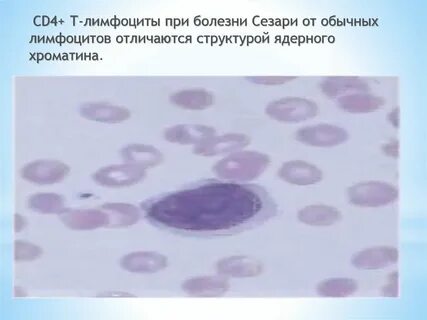 Тест синдром сезари ответы